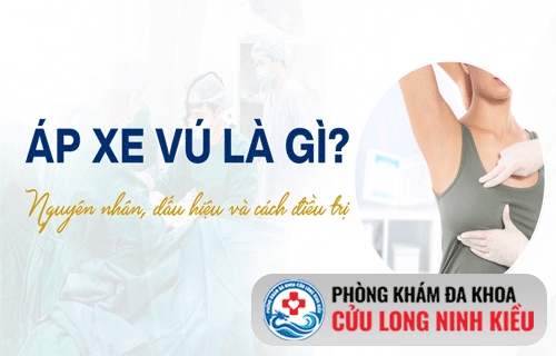 Áp xe vú- Đừng chủ quan!