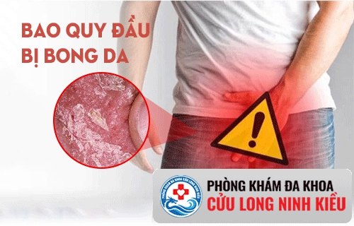 Bao quy đầu bị bong da phải làm thế nào ?