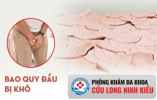 Bao quy đầu bị khô là dấu hiệu của bệnh gì ?