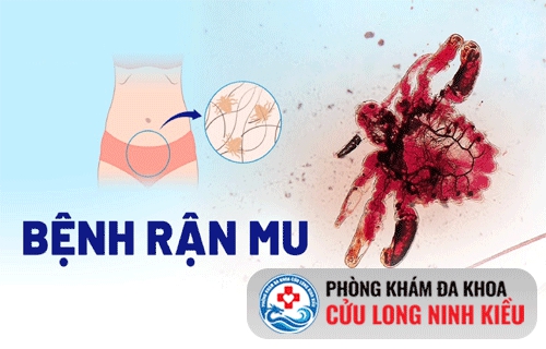 Rận mu và những điều cần biết