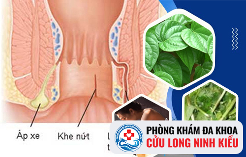 Cách chữa Apxe hậu môn tại nhà hiệu quả
