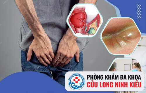 Những thông tin về Apxe hậu môn cần lưu ý