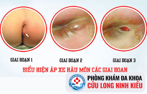 Thông tin về bệnh Apxe cạnh hậu môn