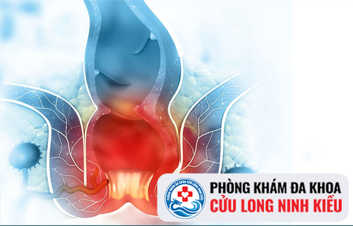 Hỗ trợ điều trị Apxe hậu môn hiệu quả không khó