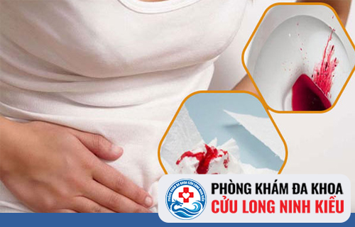 Chảy máu hậu môn - Nguyên nhân và phương pháp chữa trị