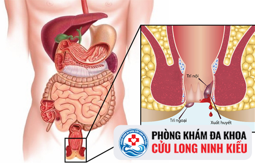 Táo bón có phải nguyên nhân gây ra bệnh trĩ hay không?
