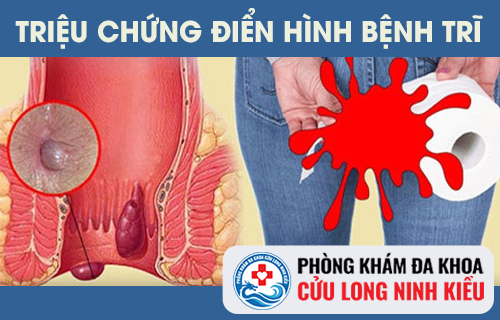 Những triệu chứng điển hình của bệnh trĩ