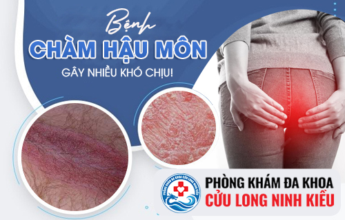 Chàm hậu môn là căn bệnh như thế nào?