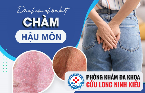 Biểu hiện chàm hậu môn người bệnh không nên chủ quan bỏ qua