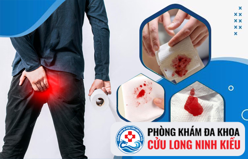 Cách chữa đi cầu ra máu hiệu quả