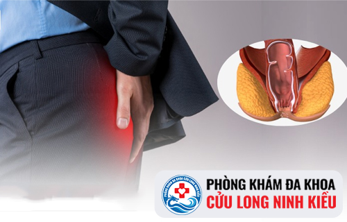 Hẹp hậu môn và phương pháp điều trị