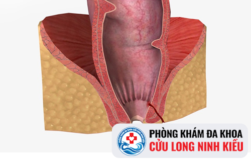 Nguyên nhân, triệu chứng bệnh hẹp hậu môn