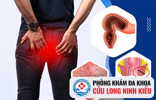 Bệnh mạch lươn là gì?