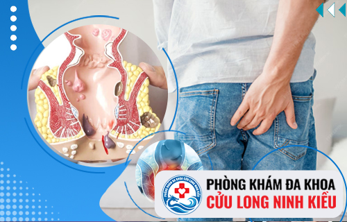 Ngứa hậu môn có phải biểu hiện của bệnh trĩ?