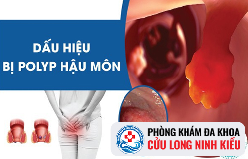 Polyp hậu môn là căn bệnh như thế nào?