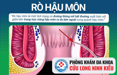 Nguyên nhân, triệu chứng bệnh rò hậu môn