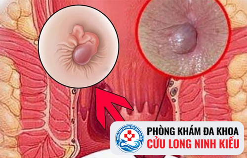 Dấu hiệu nhận biết bệnh sa búi trĩ chính xác nhất