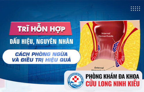 Các dấu hiệu trĩ hỗn hợp cần lưu ý