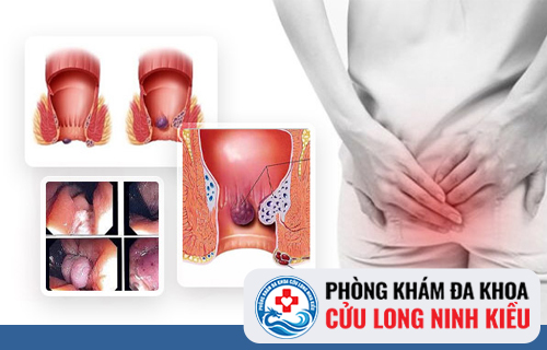 Trĩ hỗn hợp là gì?
