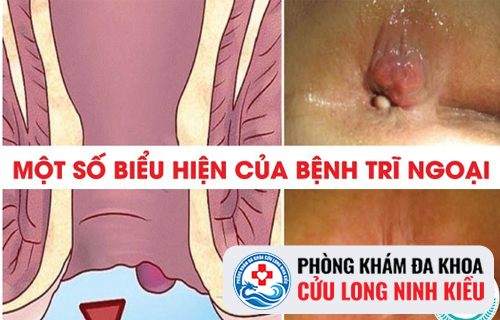 Nhận biết bệnh trĩ ngoại