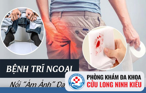 Trĩ ngoại là gì? Cách nhận biết và điều trị bệnh trĩ ngoại