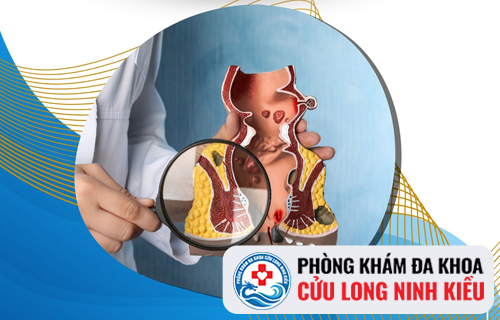 Nhận biết ngay các dấu hiệu bệnh trĩ ngoại