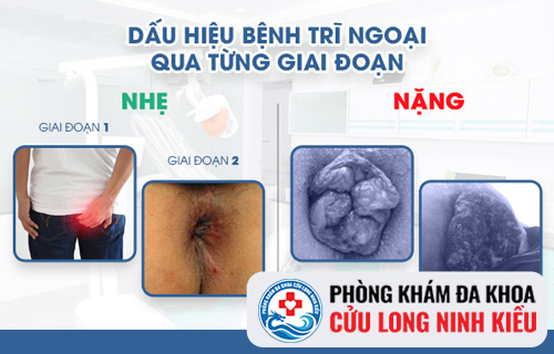 Những thông tin quan trọng về bệnh trĩ ngoại