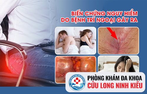 Điều trị bệnh trĩ bằng phương pháp Longo