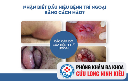Nhận biết ngay các cấp độ trĩ ngoại