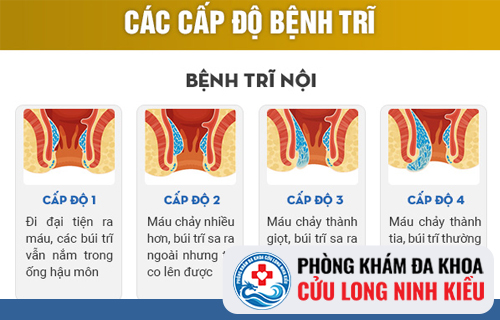 Bệnh trĩ nội đe dọa cuộc sống của người bệnh