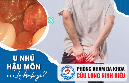 U nhú hậu môn là căn bệnh gì?