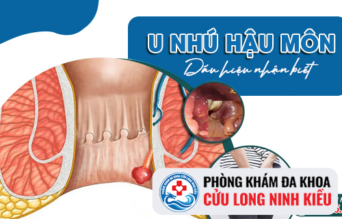 Dấu hiệu u nhú hậu môn đừng bỏ qua