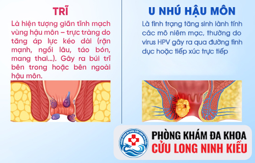Phân biệt u nhú hậu môn và trĩ
