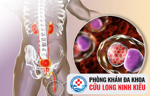 Chlamydia là bệnh gì?