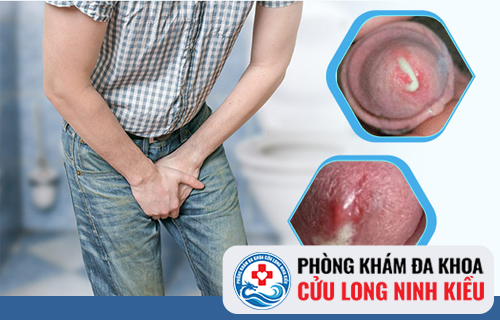Những bệnh lây truyền qua đường tình dục