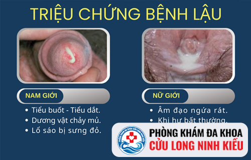Triệu chứng của bệnh lậu là gì?
