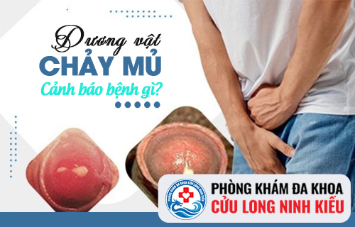 Dương vật chảy mủ báo động bệnh lâu đe dọa tính mạng