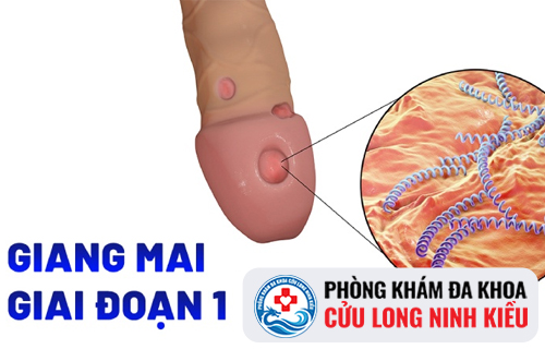 Giang mai giai đoạn 1 là gì?