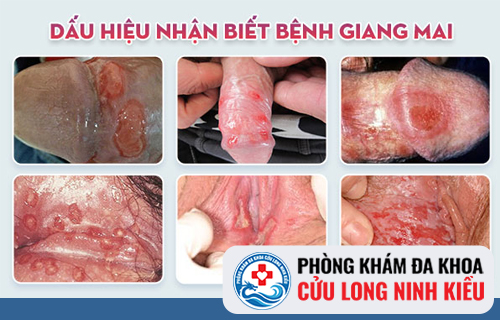 Biểu hiện của bệnh giang mai