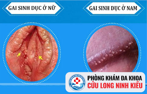 Hình ảnh gai sinh dục ở rãnh bao quy đầu của nam giới