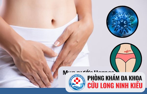 Những thông tin quan trọng về Bệnh Herpes