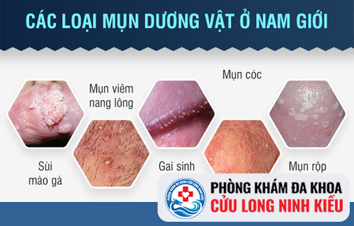 Cảnh báo nổi mụn vùng kín bất thường ở nam giới