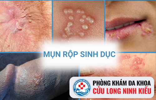 Nguyên nhân gây ra bệnh mụn rộp sinh dục tái phát