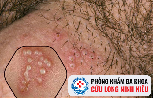 Bật mí những cách hạn chế tình trạng mụn rộp sinh dục tái phát