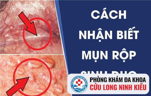 Làm thế nào để hạn chế mụn rộp sinh dục tái phát?