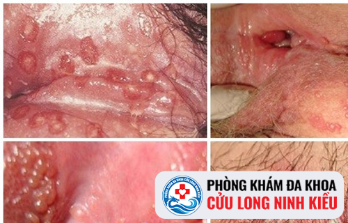 Mụn vùng kín do các bệnh xã hội gây ra