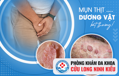 Mụn thịt ở dương vật là dấu hiệu sùi mào gà