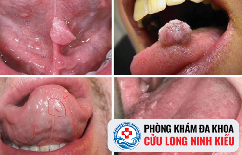 Cuộc chiến của sùi mào gà ở lưỡi mãi không vơi