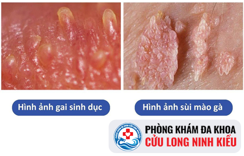 Hình ảnh gai sinh dục và sùi mào gà khác nhau như thế nào?