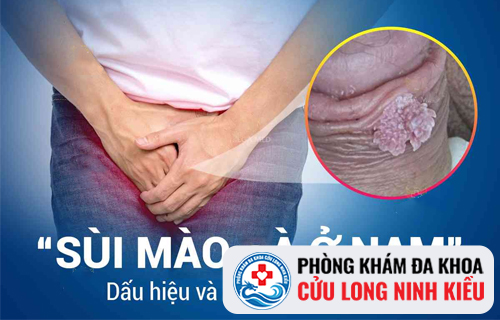 Hình ảnh sùi mào gà ở dương vật